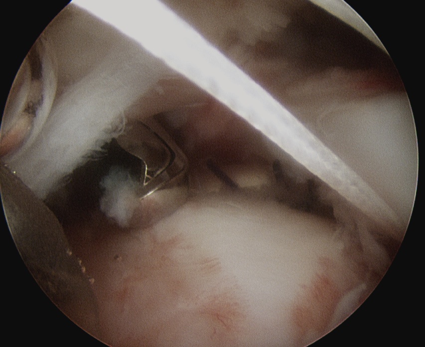 SSC Debridement Anterior Subacromial